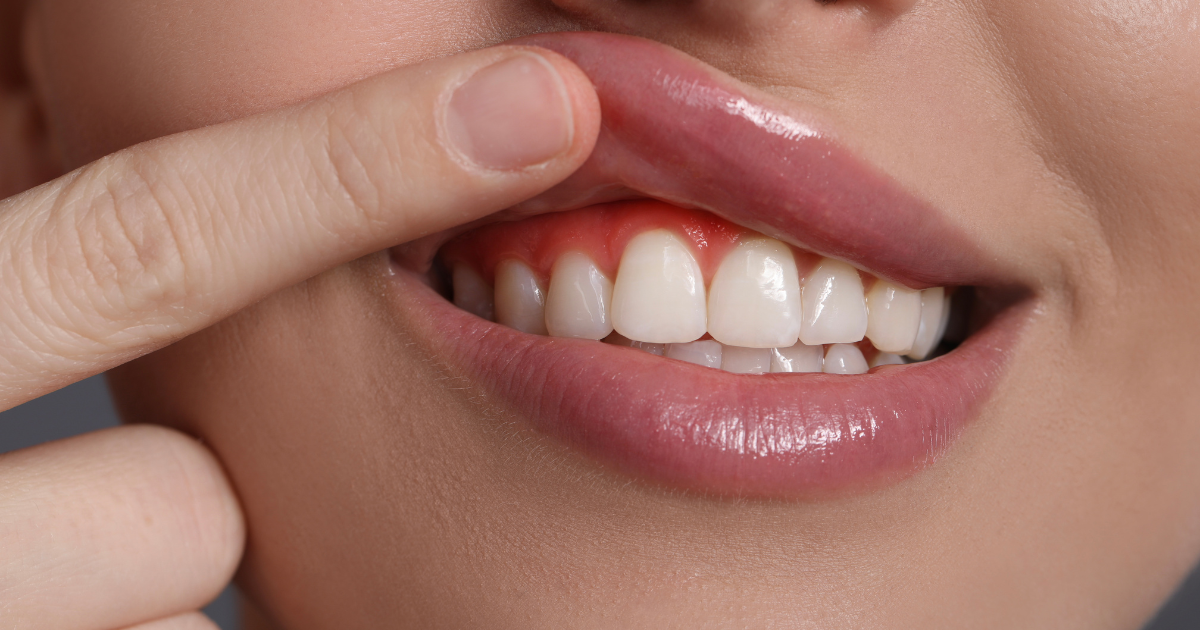  Sangrado de encías: por qué ocurre y cuándo acudir al dentista